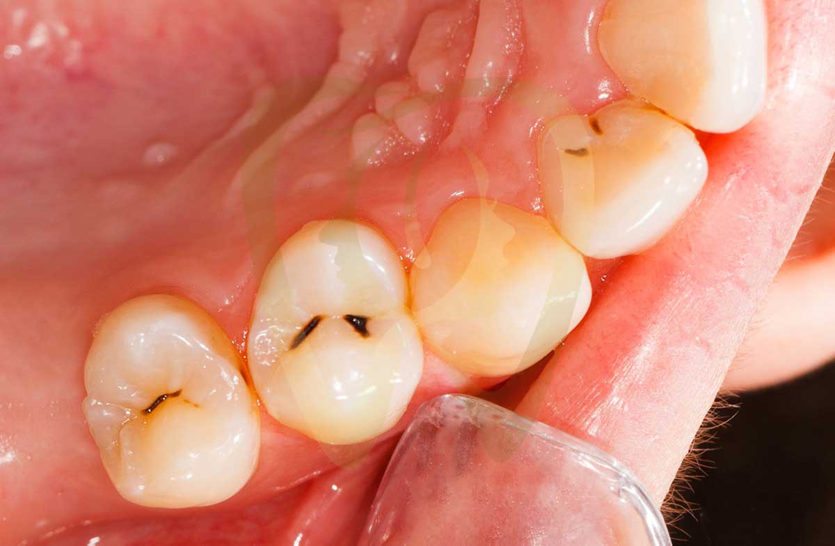 What Does a Cavity Look Like? A Complete Guide to Recognizing Tooth Decay