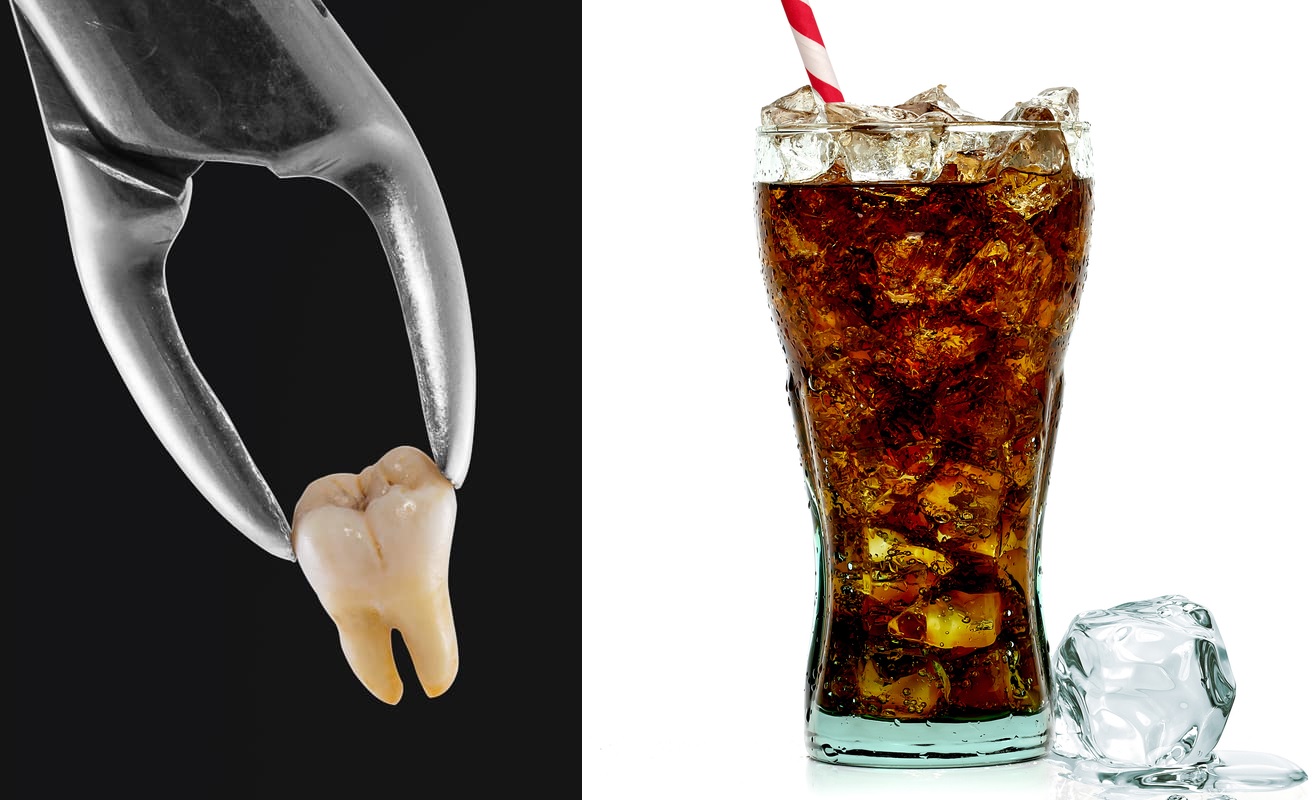 When Can I Drink Soda After Tooth Extraction? A Complete Guide to Post-Extraction Care and Drinking Carbonated Beverages