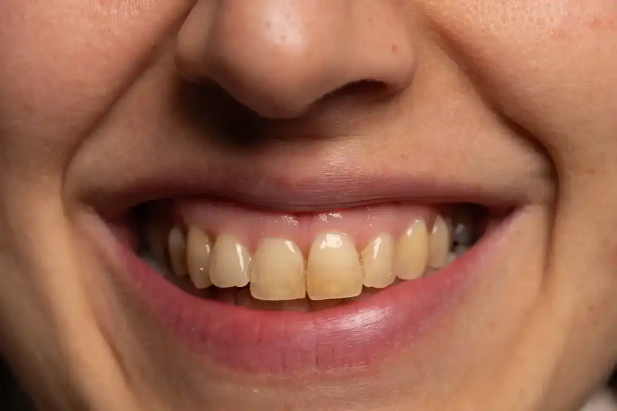 Why Are My Teeth Yellow? How to Get Rid of Yellow Teeth and Make Them White Again