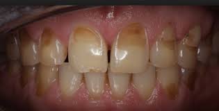 Why Enamel Erosion Causes Tooth Discoloration: A Detailed Exploration