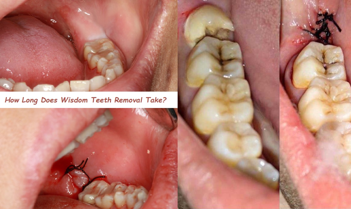 How Long Does Wisdom Teeth Removal Take? A Complete Guide to the Procedure and Recovery