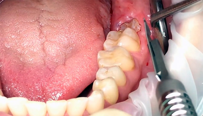 Wisdom tooth pain area- Inflamed area around wisdom tooth hurt when mouth closes