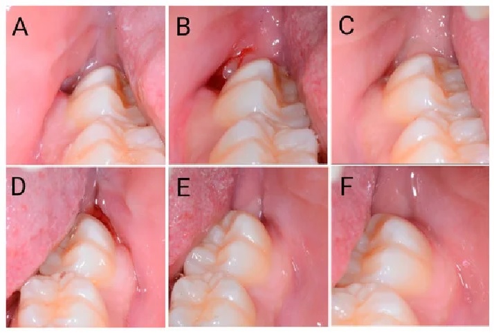 Wisdom tooth removal wound healing stages.