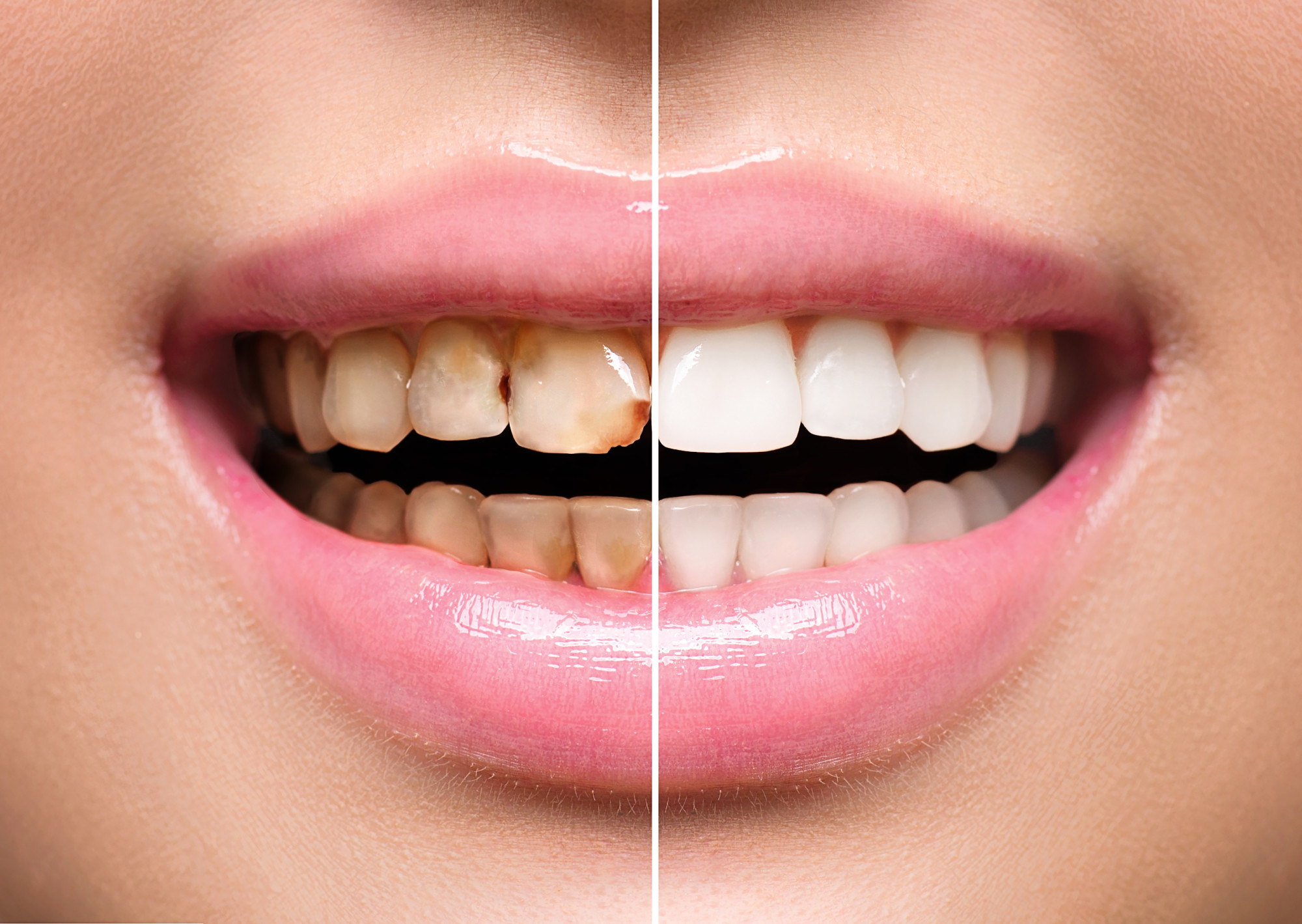 Can You Get Veneers with Bad Teeth? Everything You Need to Know About Transforming Your Smile with Veneers