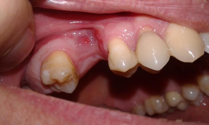 Wound healing after weeks of tooth extraction