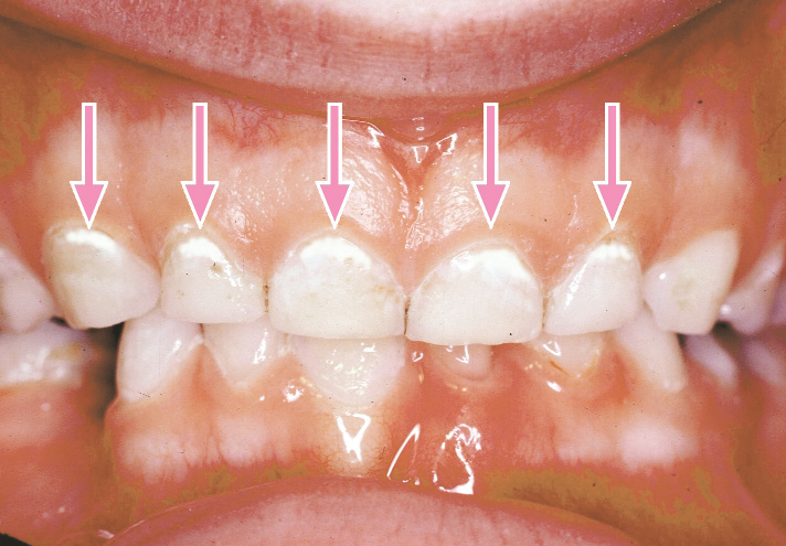 How to Recognize Early Signs of Tooth Decay in Kids