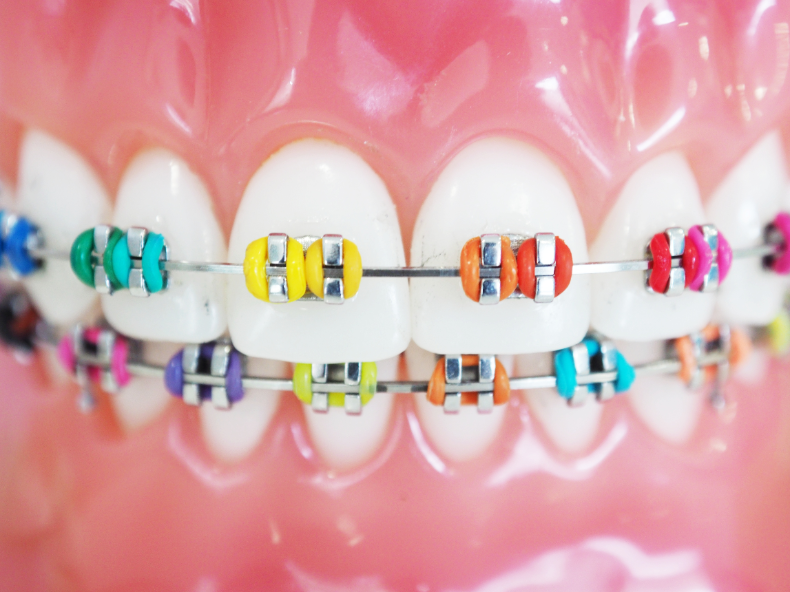 best braces colors, braces color, popular cute braces colors