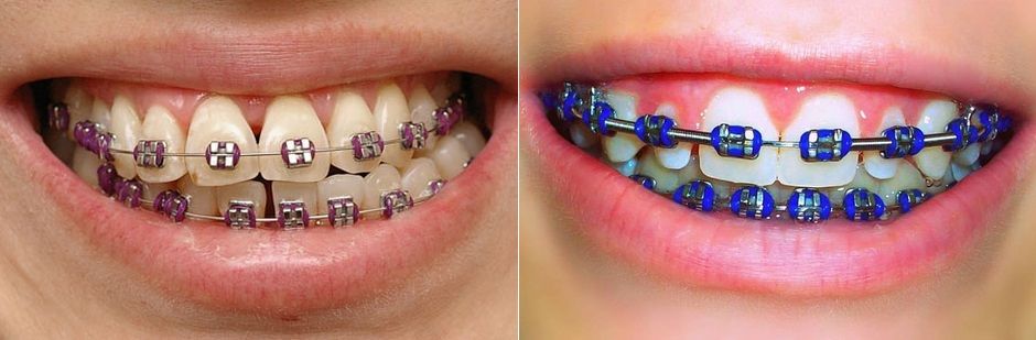 best braces colors, braces color, popular cute braces colors