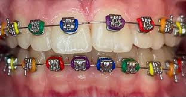 best braces colors, braces color, popular cute braces colors