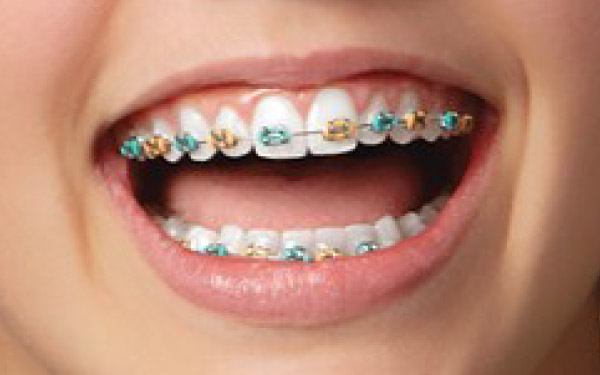 best braces colors, braces color, popular cute braces colors