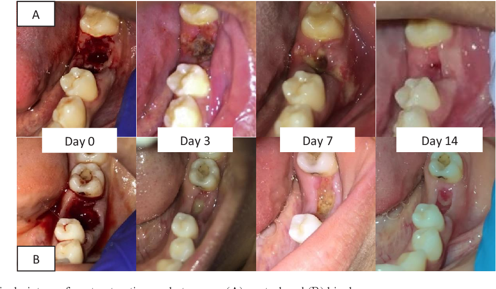 binahong leaf extract gel on the wound healing process of post tooth extraction