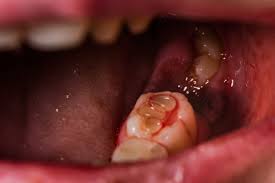 blood clot formation in dental socket after tooth extraction