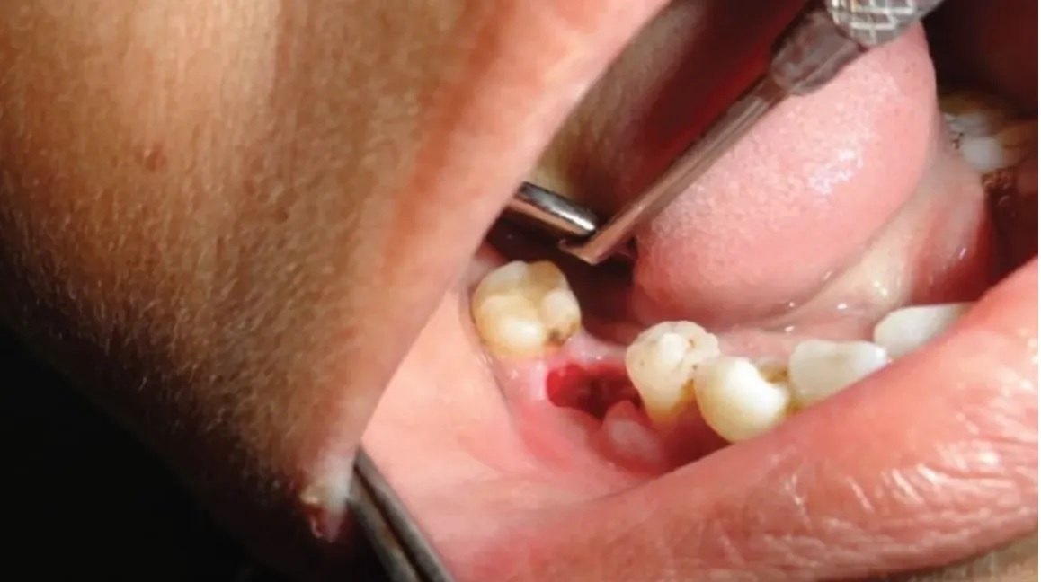 blood clot formation in tooth socket after tooth extraction 