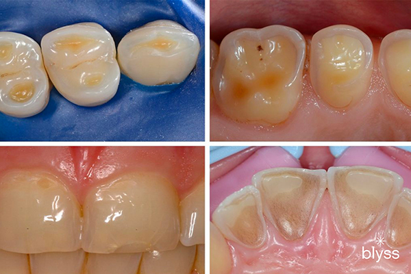 Do Translucent Teeth Indicate a Serious Oral Health Problem?