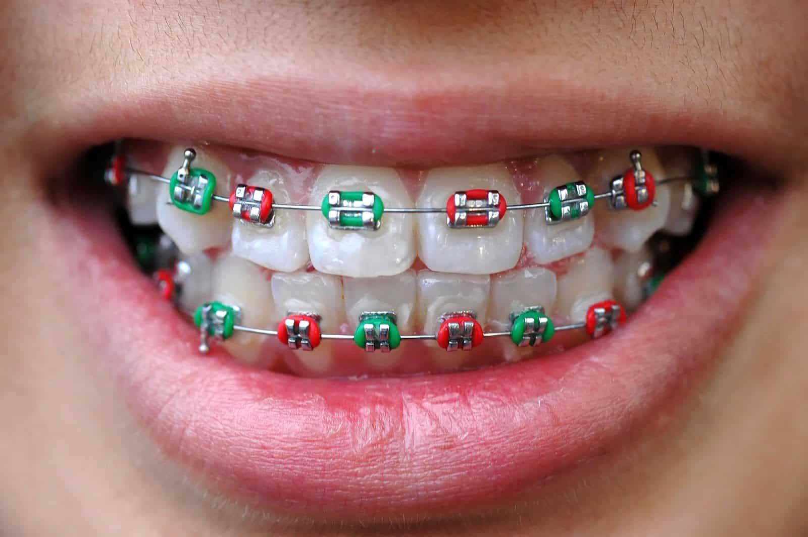 Best Braces Colors: How to Choose Popular and Cute Braces Colors for Your Smile