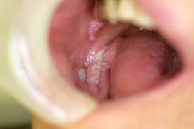 cancer mouth cyst.