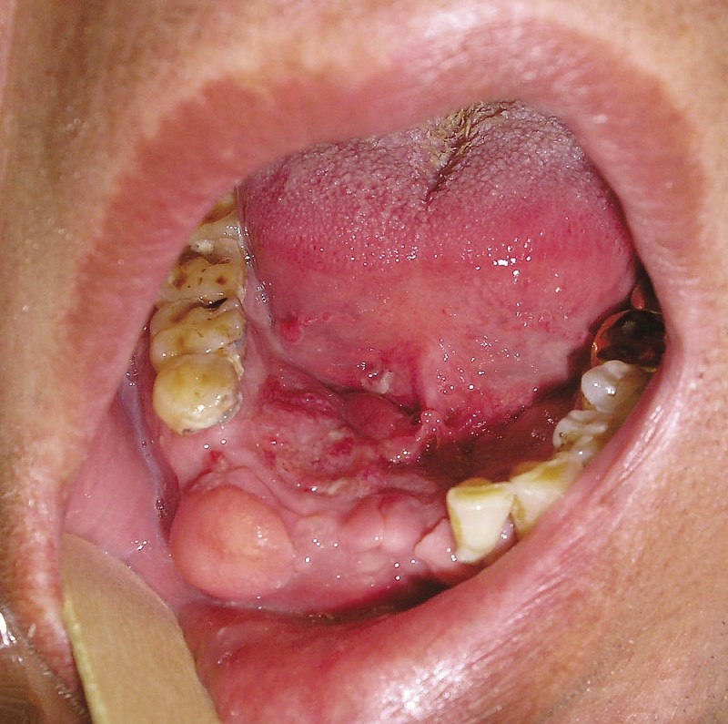 Cancer mouth cyst. cancer lump on jawline, non movable lump on jaw bone, hard lump on jaw bone under skin, 