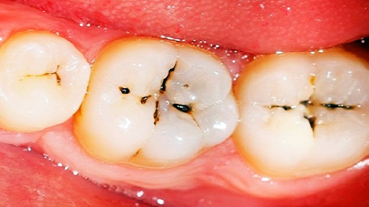 Tooth decay cavity in pits and fissure of tooth .What Does a Cavity Look Like? A Complete Guide to Recognizing Tooth Decay