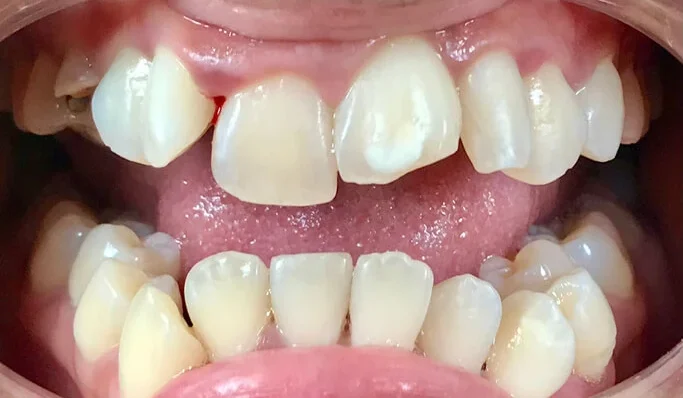 The Impact of Teeth Misalignment on Overall Health: Beyond Oral Health