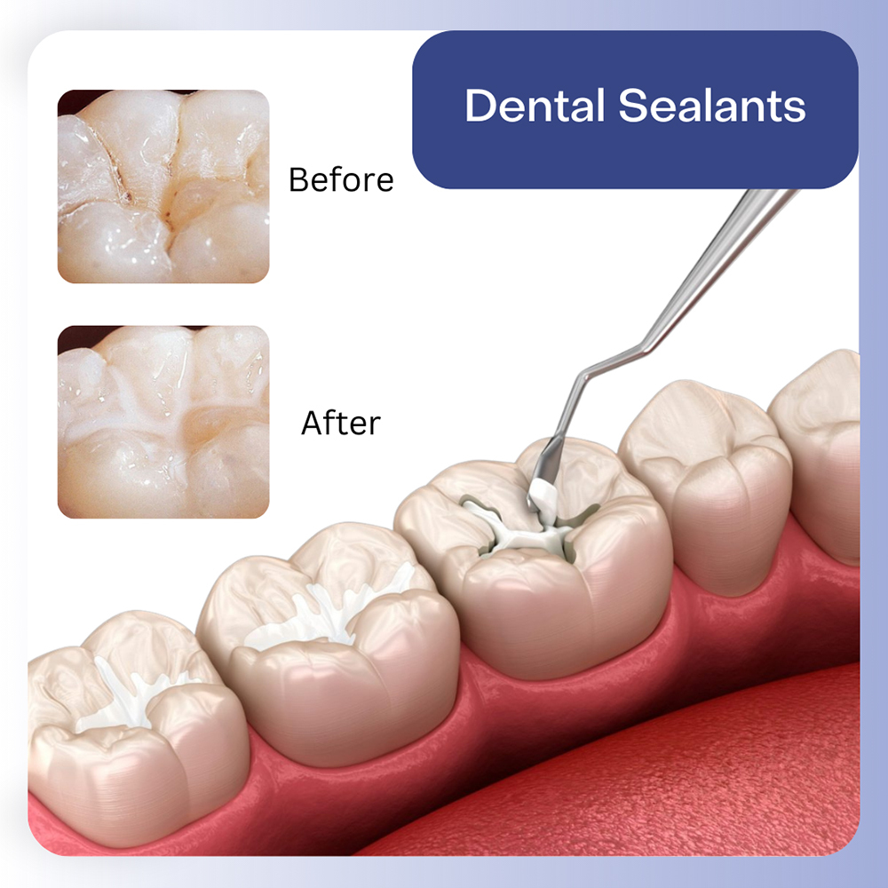 Sealants: An Extra Layer of Protection Against Cavities