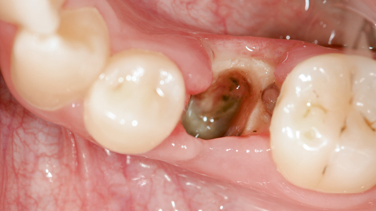 Dry Socket formation after tooth extraction.