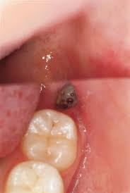 Dry Socket formation after wisdom tooth extraction.