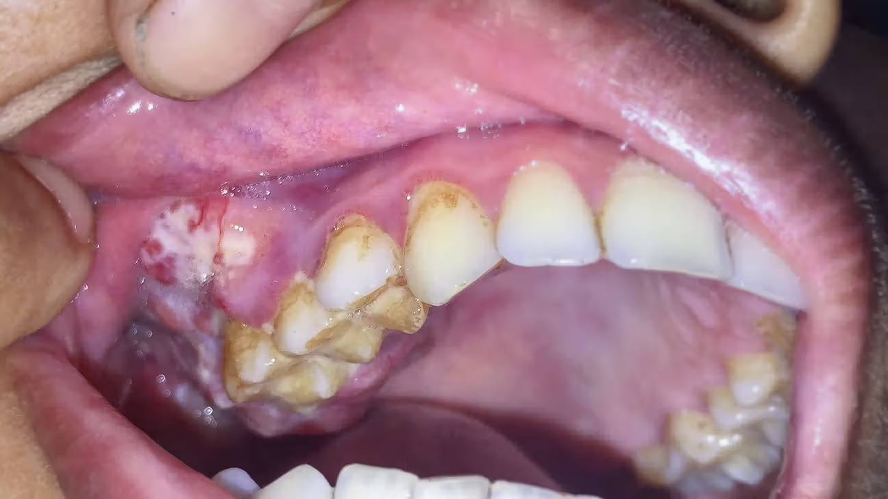 Erythroleukoplakia-oral cancer mouth cancer  image