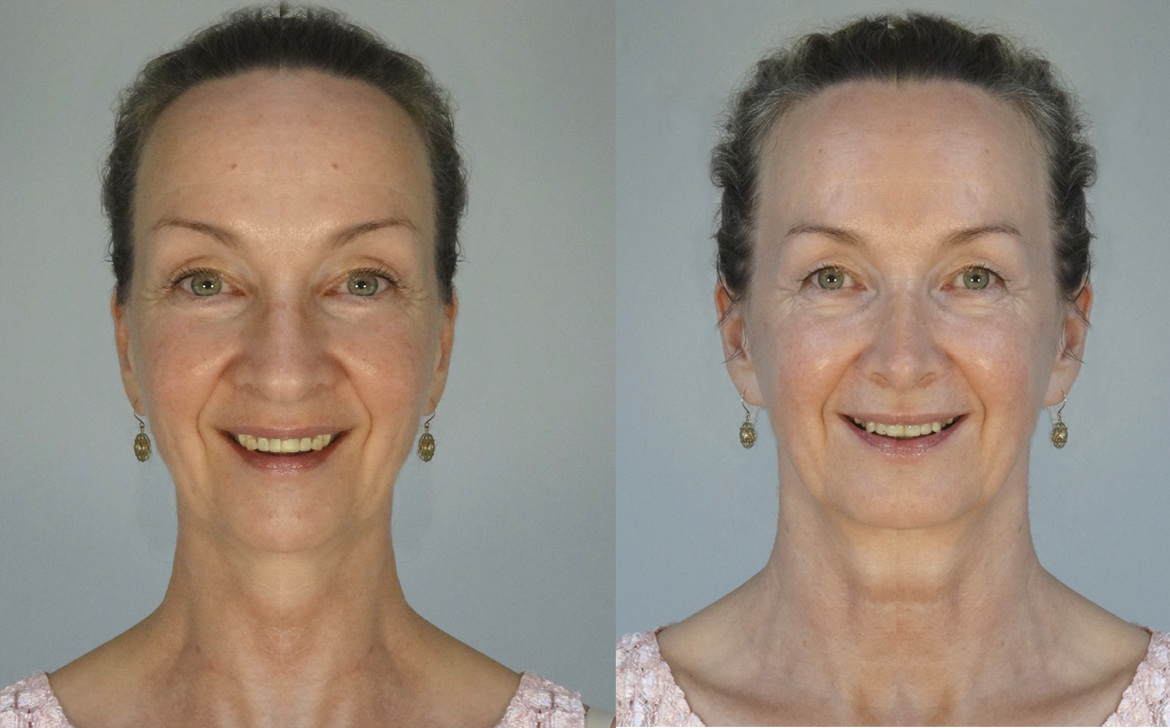 facial-asymmetry- due -to-age-Asymmetrical Face