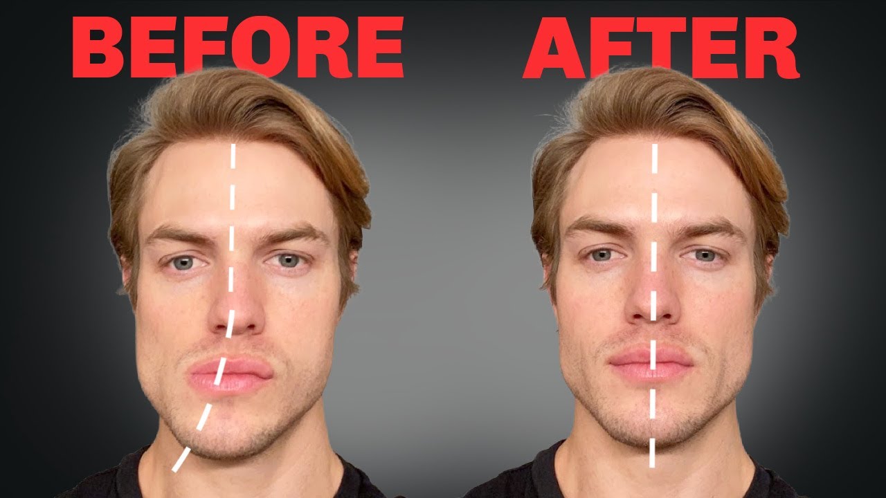 facial-asymmetry- due -to-posture-Asymmetrical Face