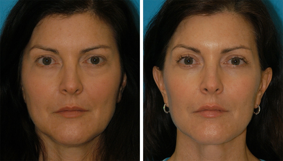 facial-symmetry- due -to-occlusion-how to fix facial asymmetry from sleeping on side naturally Asymmetrical Face. 