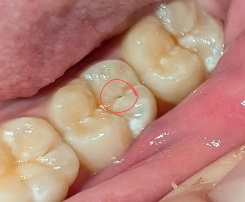 flouride toothpaste use and low sugar intake can arrest small caries and reverse cavities formation