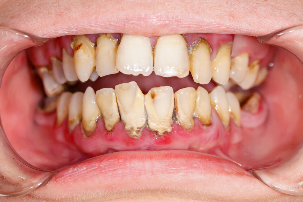 gingivitis plaque on teeth, how to dissolve plaque on teeth