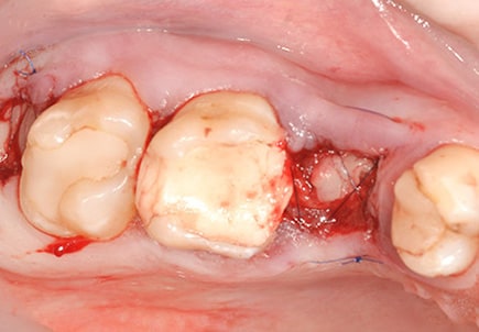 graft placed in tooth normal socket and sutured to promote healing and preserve anatomy of normal socket after tooth extraction