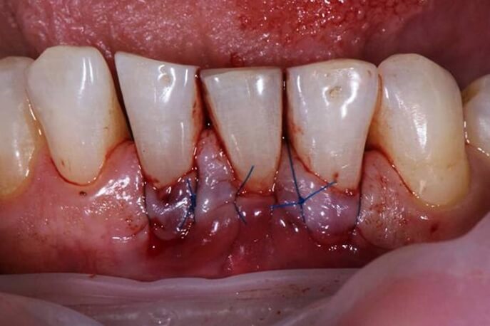 Gum disease treatment of Flap surgery to place health gums graft on site and suture it to nearby healthy gums