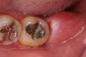 swollen gums in back of mouth. gum pain in back of mouth not wisdom teeth.