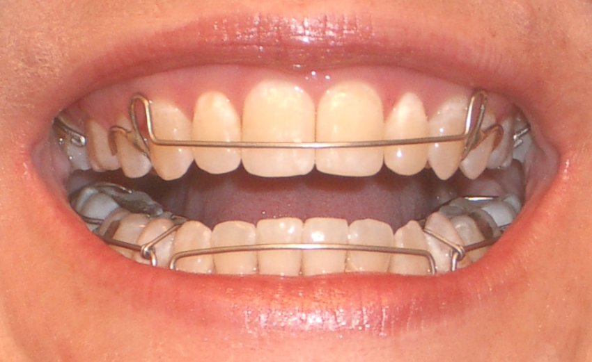 Hawley retainers for upper and lower teeth inside mouth