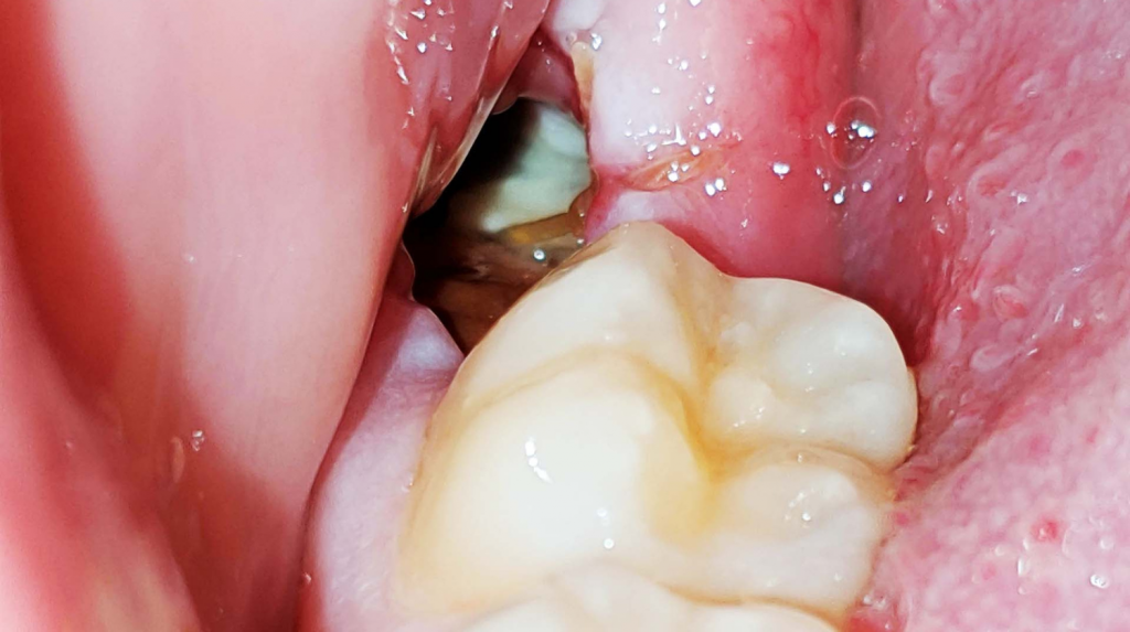 picture of dry socket formation after tooth extraction delaying the healing of socket and causing pain