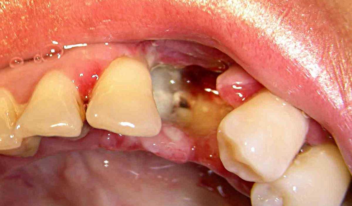 what does an infected tooth extraction look like. Infected gums socket after a tooth extraction