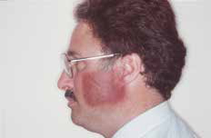 jaw cancer Picture lump and scare on Jaw 2