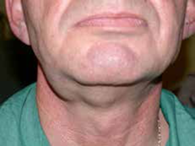 Jaw cancer Picture lump on Jaw 