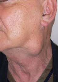 jaw cancer Picture lump on Jaw