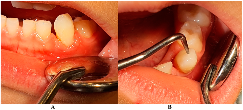 loose-tooth-A-Gingival-inflammation-B-advanced-tooth-mobility-which-led-to-the-LPP-diagnosis