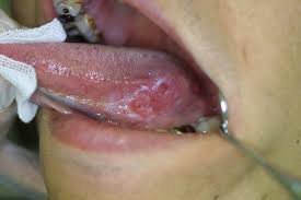 Tongue cancer picture