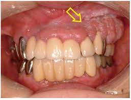 Gum cancer picture