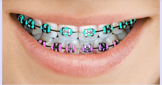 Best Braces Colors: