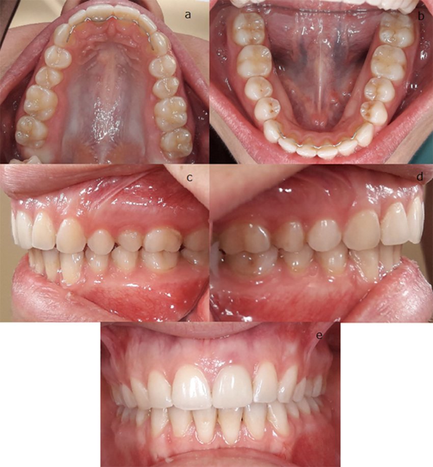 Intra-Oral Picture showing human 32 upper and Lower teeth ( 8 incisor teeth 4 canine teeth, 8 premolar teeth and 12 Molar teeth)