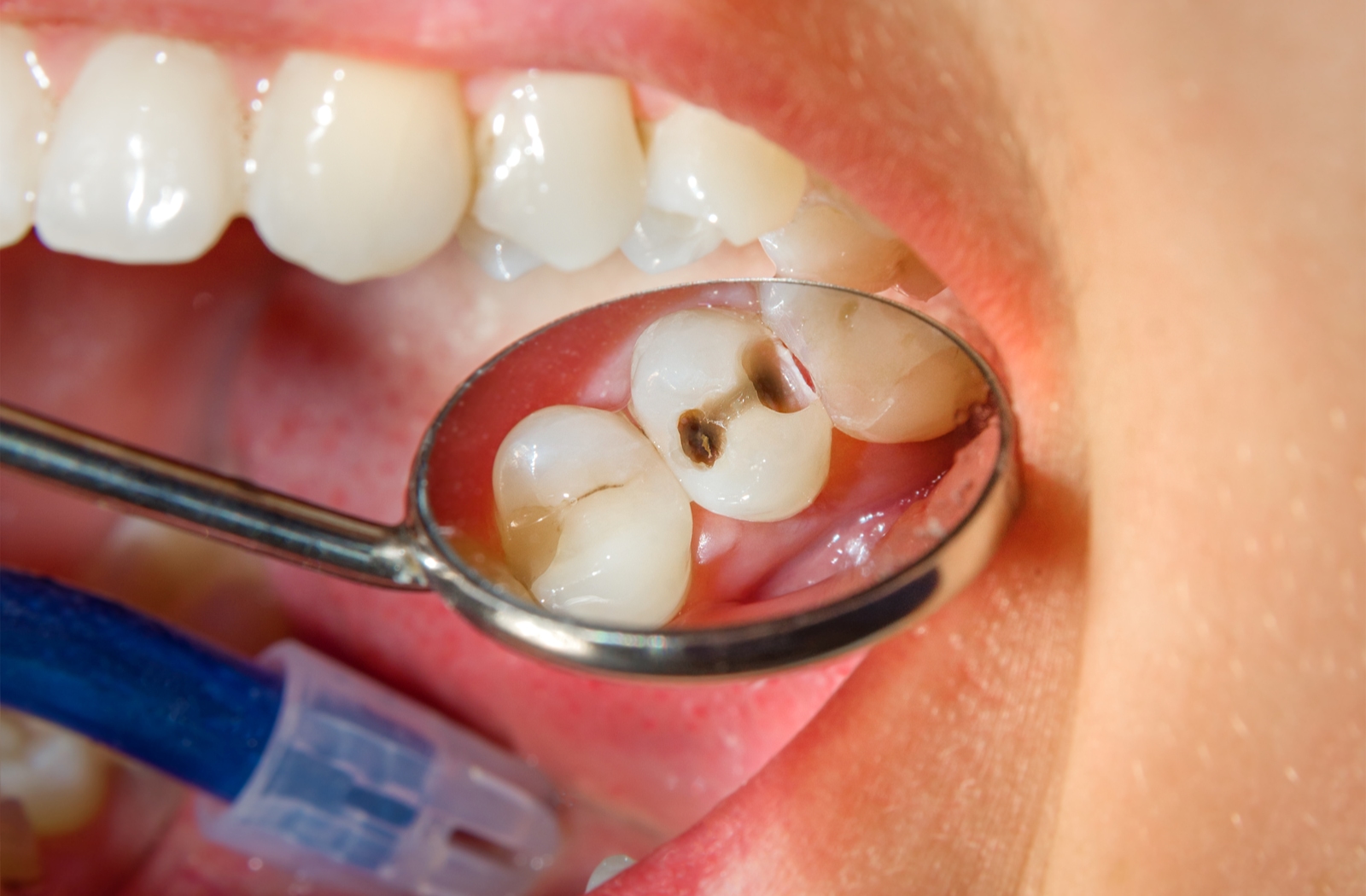 Treatment Options for Rotten Teeth: From Fillings to Extractions