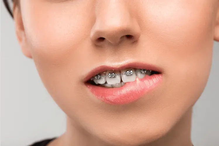 How Braces Fix Dental Issues of Buck Teeth: A Comprehensive Guide