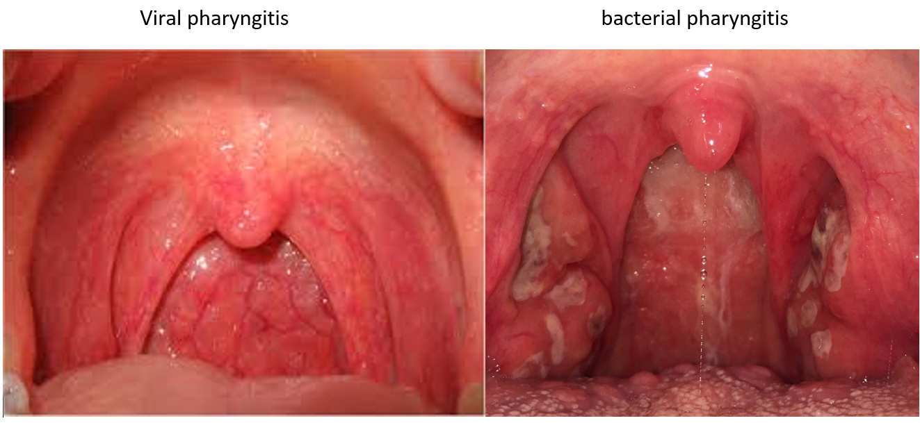 ear and throat pain on one side remedies, sore throat and ear pain on one side, how to get rid of sore throat and clogged ears