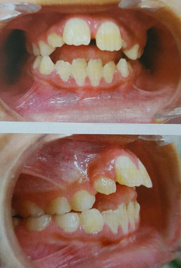 Buck Teeth from Thumbsucking: How a Childhood Habit Can Lead to Long-Term Dental Issues